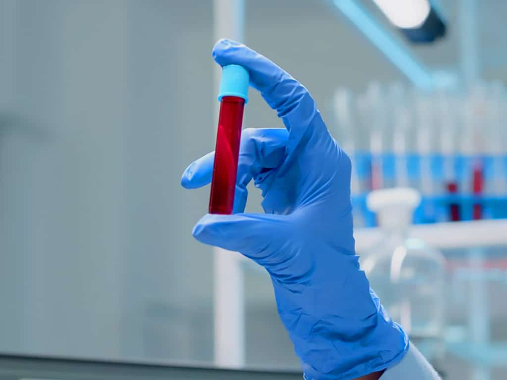 A lab technician holding a container with blood sample