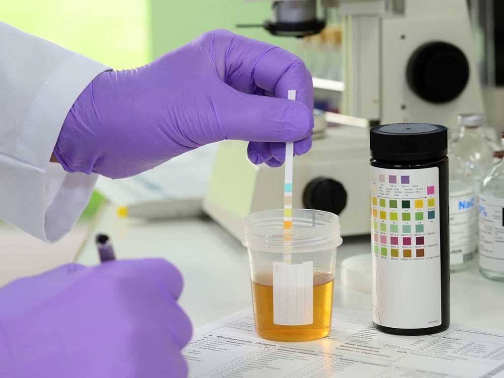A technician immersing a test strip into the urine sample