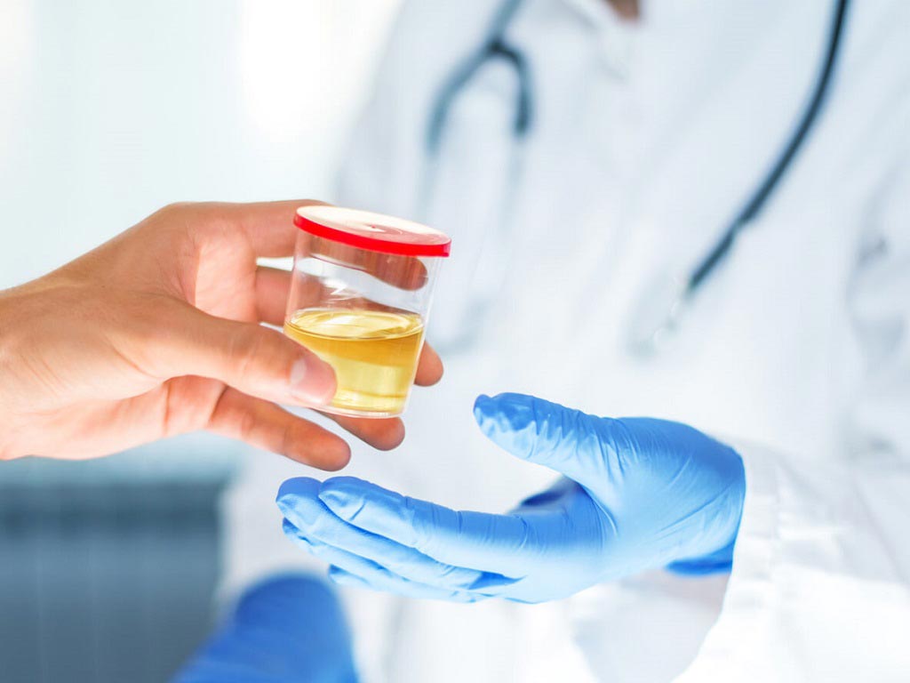 Individual giving a urine sample to a healthcare professional for testing.