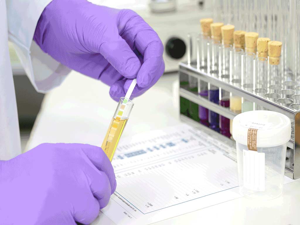A technician dipping a test strip from urine sample in a test tube