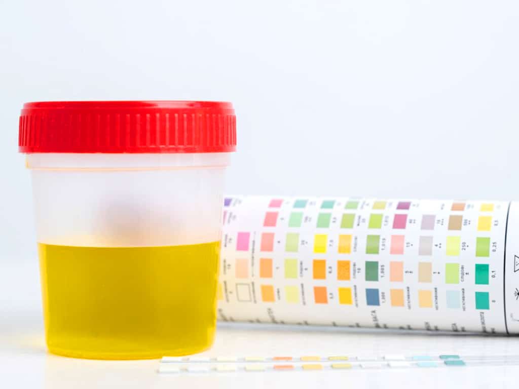 A urine sample container and a colour chart indicator