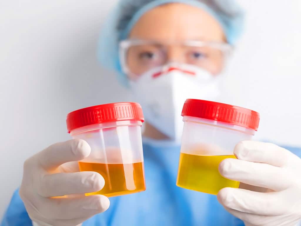 A lab technician holding two urine sample containers