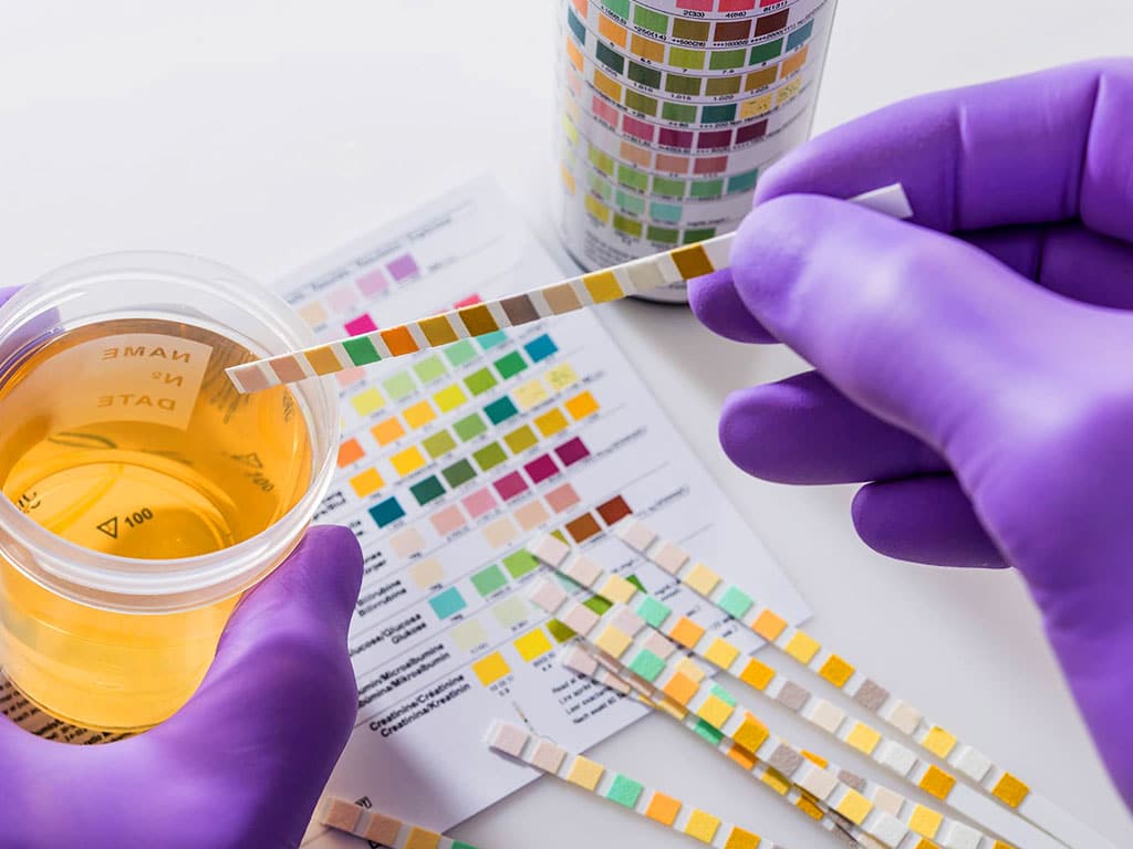 A medical professional immersing a test strip into a urine specimen cup sample