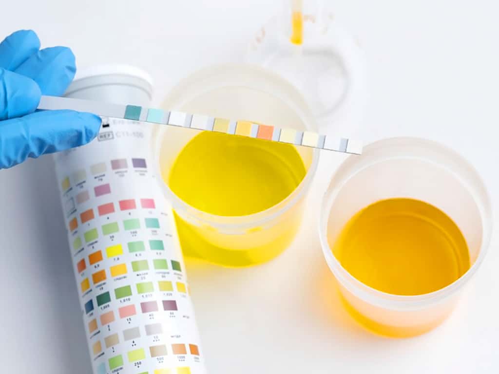 A professional analysing urine samples using a colour chart