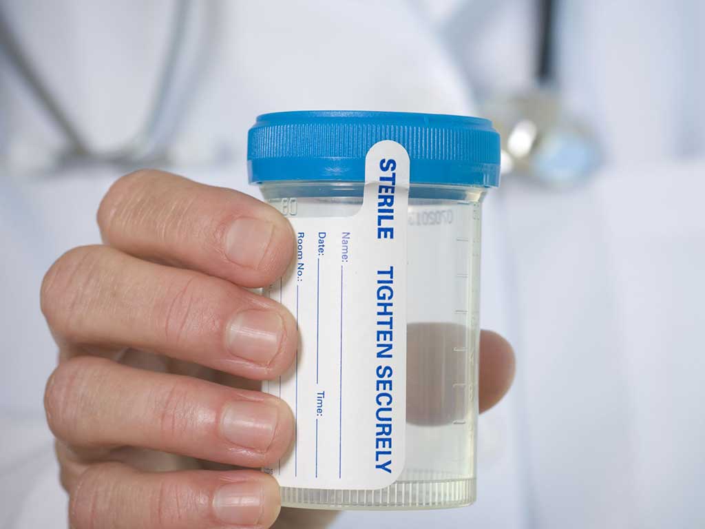 A health professional holding an empty urine specimen cup