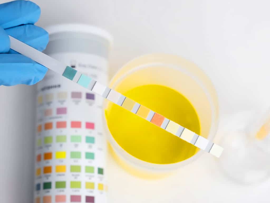 A person holding a strip over a urine sample