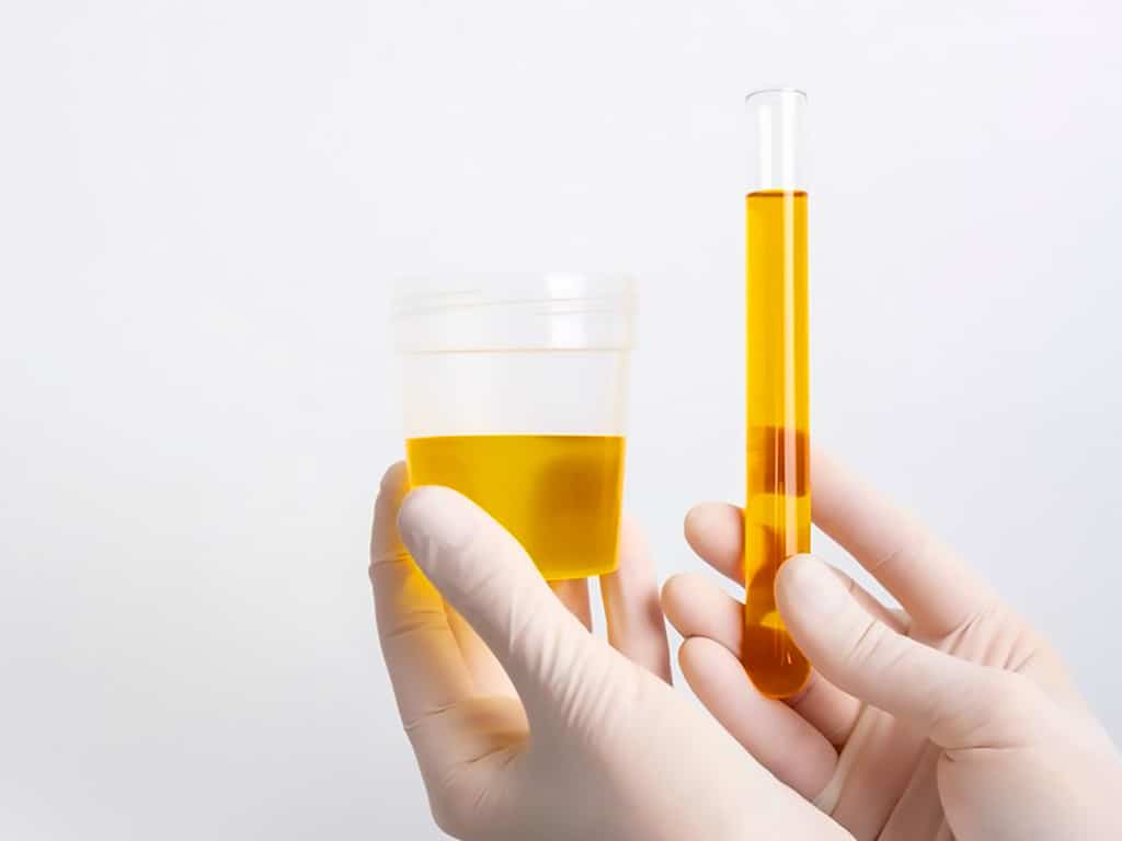 A professional wearing gloves showing urine samples in a cup and in a tube