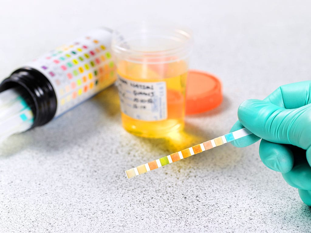 A gloved hand holding a test strip in front of a urine sample